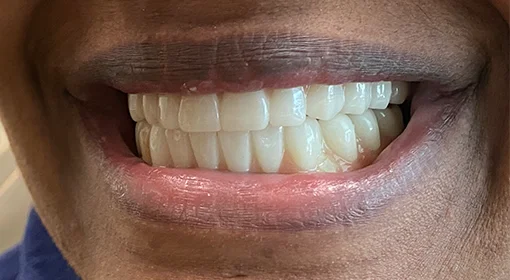 patient eleven before - Seattle Smiles Company