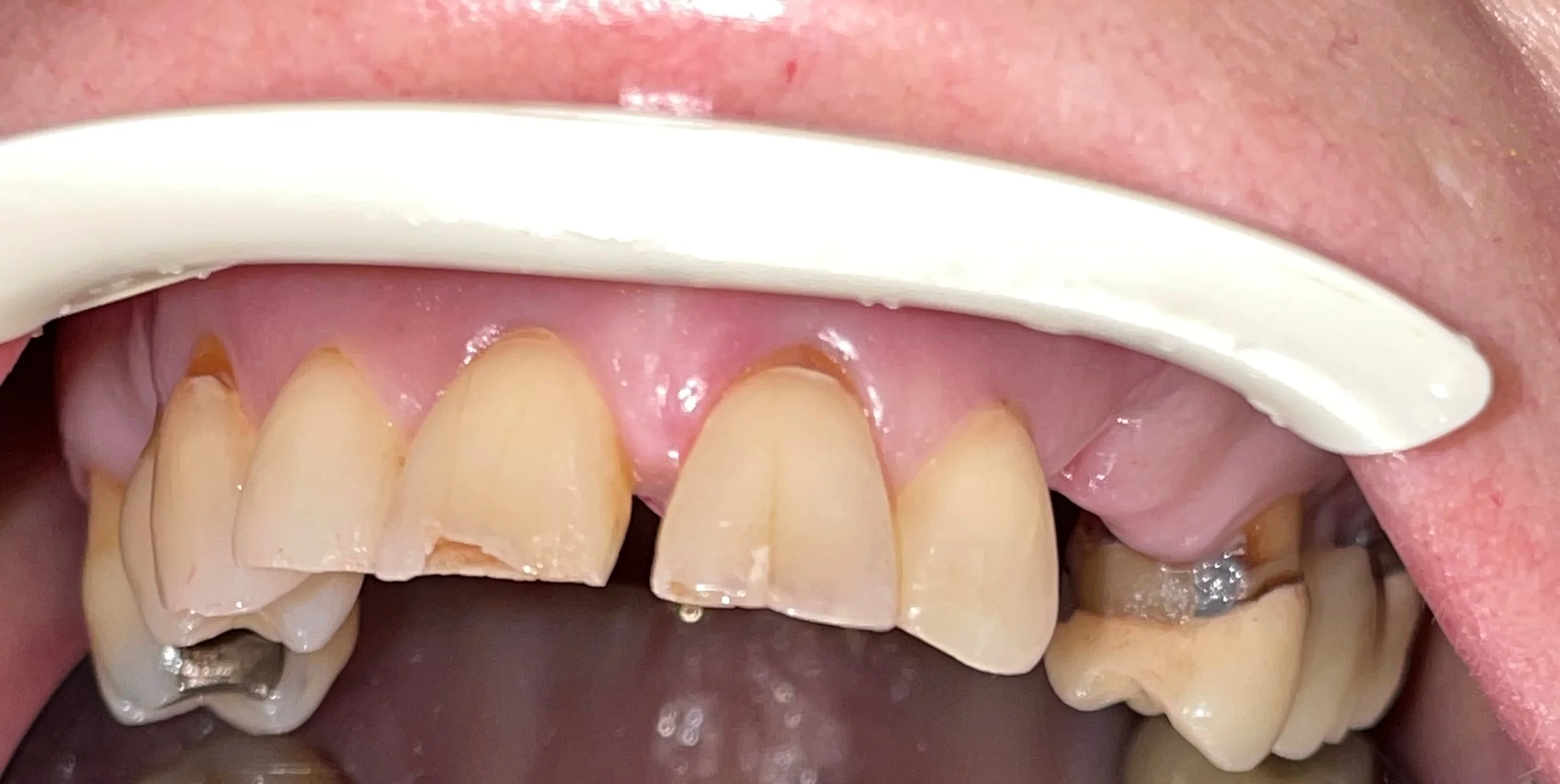 patient five before - Seattle Smiles Company