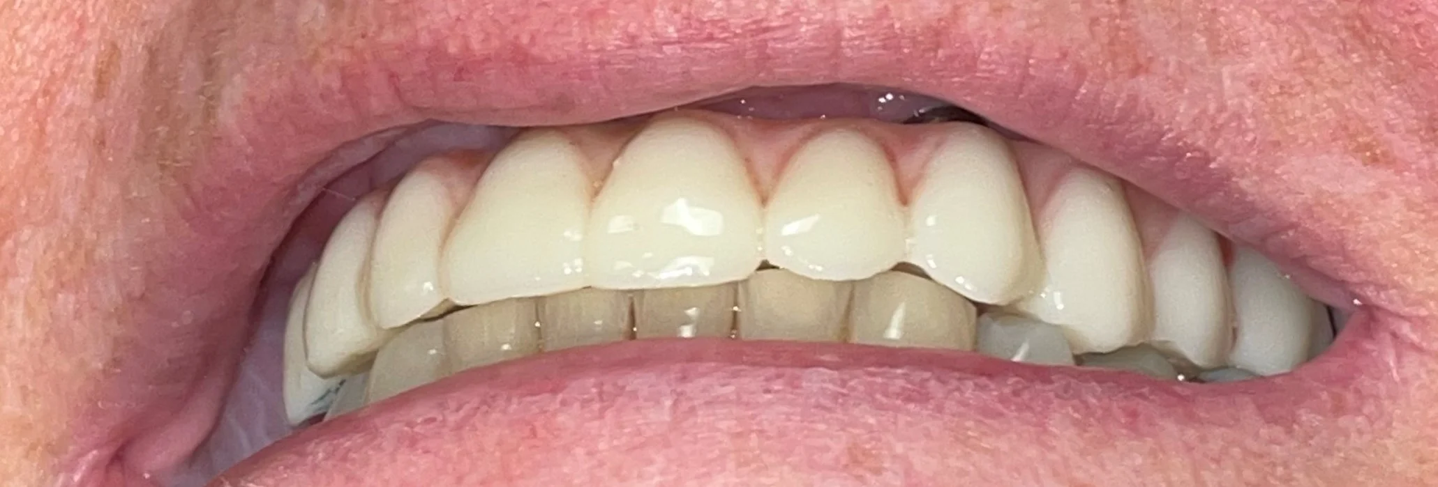 Patient Three After