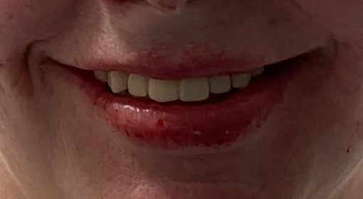 Patient Nine After