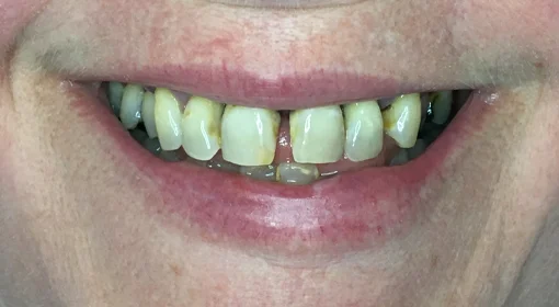 Patient Seven Before