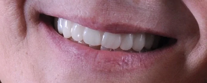 patient seven after - Seattle Smiles Company