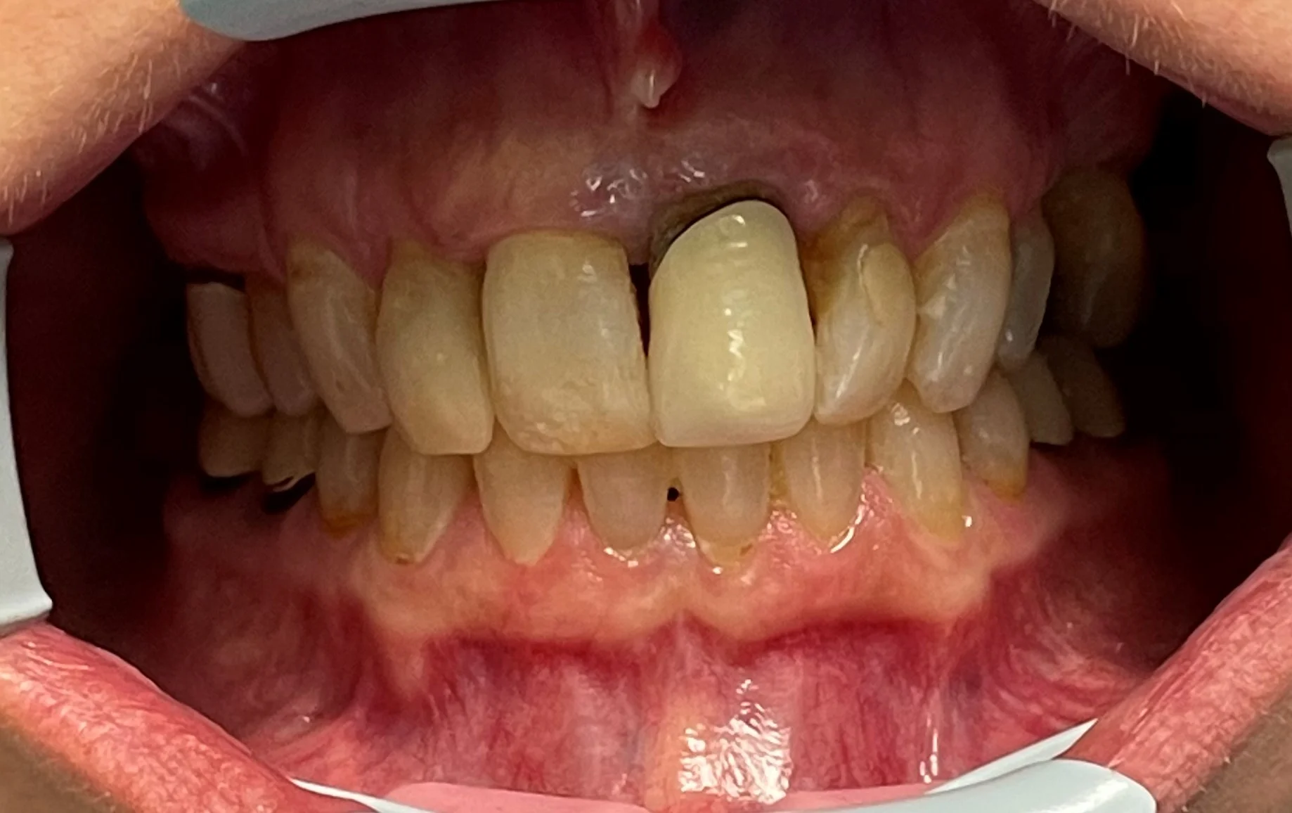 Patient Seven Before