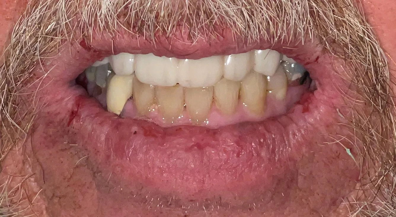 Patient Six After