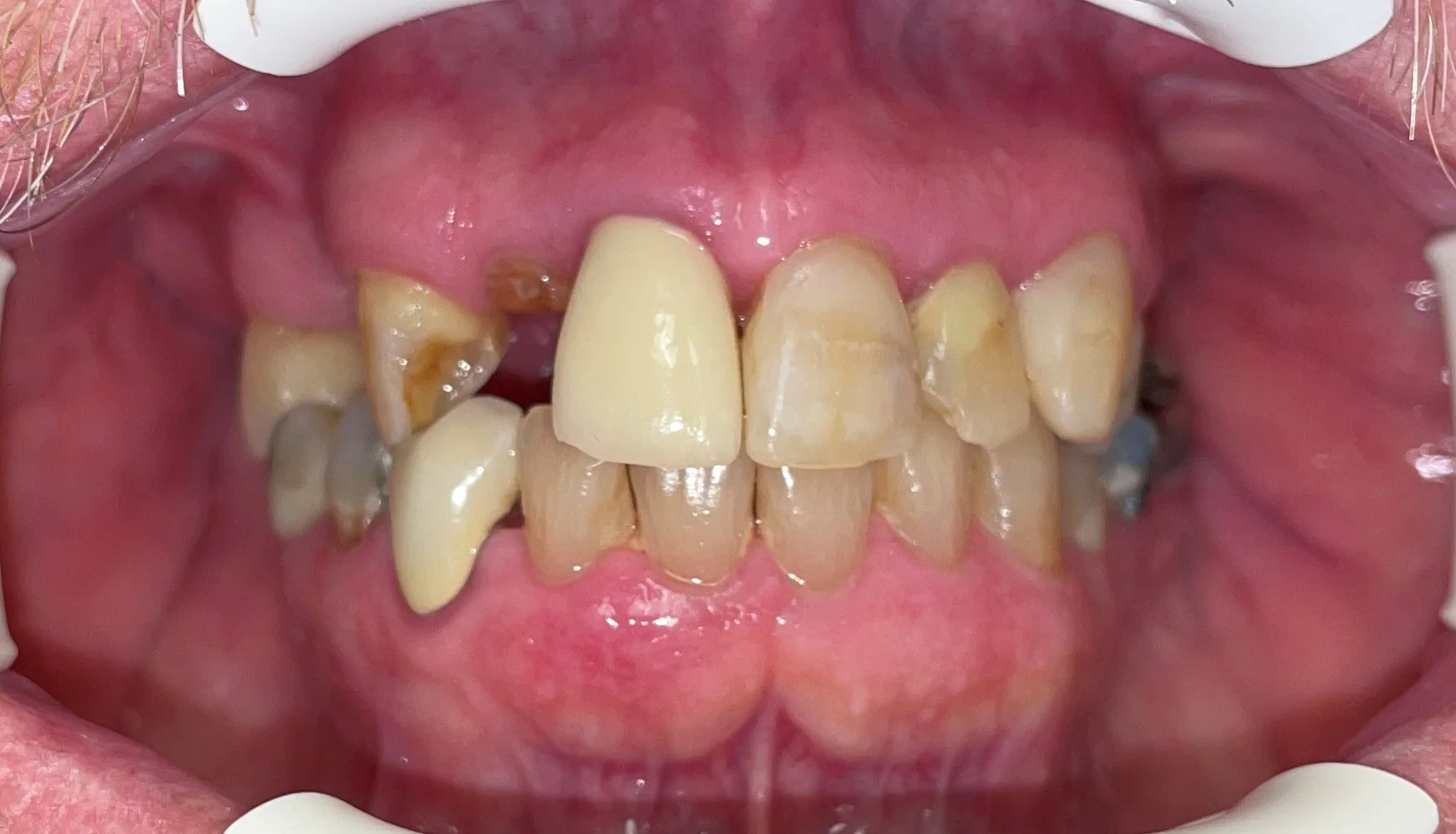 patient six before - Seattle Smiles Company