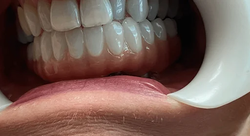 patient teeth crop after image