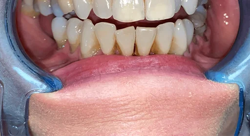 patient teeth crop before image