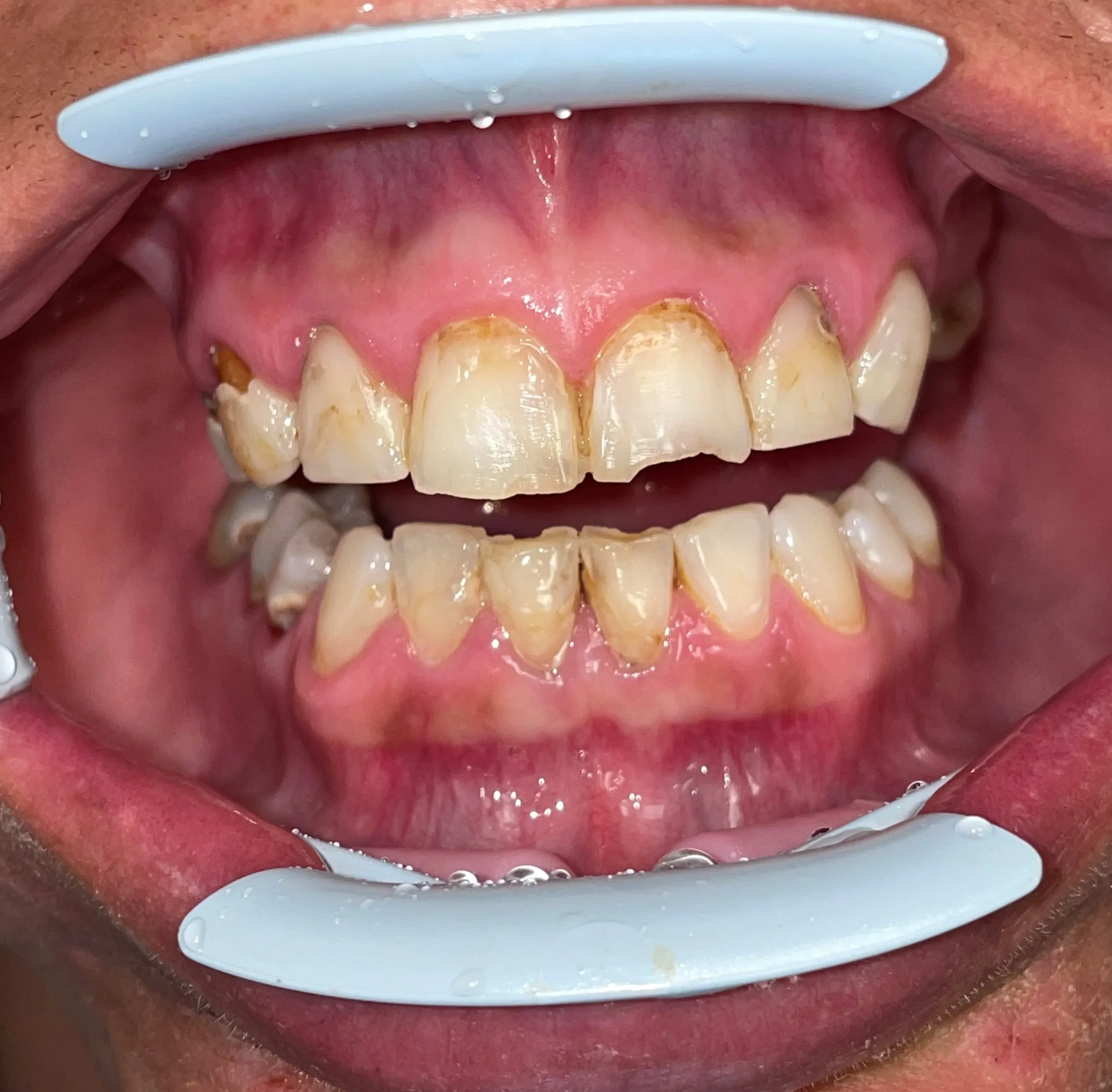 patient two before scaled - Seattle Smiles Company